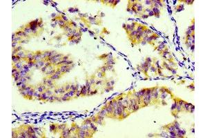 IHC image of ABIN7127283 diluted at 1:100 and staining in paraffin-embedded human endometrial tissue performed on a Leica BondTM system. (Recombinant CD74 antibody)