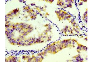 IHC image of ABIN7127283 diluted at 1:100 and staining in paraffin-embedded human endometrial tissue performed on a Leica BondTM system. (Recombinant CD74 antibody)