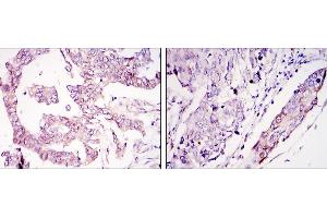 Immunohistochemical analysis of paraffin-embedded ovary tumour tissues (left) and lung cancer (right) using WIF1 mouse mAb with DAB staining.