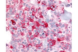 Anti-BAI2 antibody IHC of human Breast, Carcinoma. (BAI2 antibody  (N-Term))