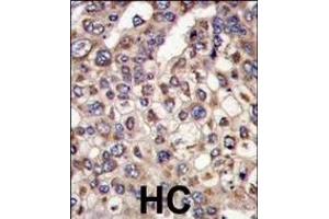 Formalin-fixed and paraffin-embedded human hepatocarcinoma tissue reacted with MTMR4 antibody (C-term), which was peroxidase-conjugated to the secondary antibody, followed by DAB staining. (MTMR4 antibody  (C-Term))