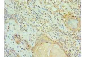 Immunohistochemistry of paraffin-embedded human breast cancer using ABIN7147295 at dilution of 1:100