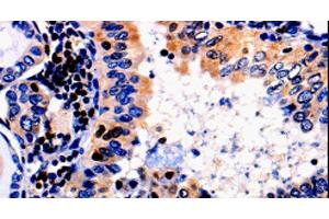 Immunohistochemistry of paraffin-embedded Human thyroid cancer tissue using ALOX5 Polyclonal Antibody at dilution 1:50 (ALOX5 antibody)