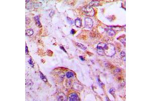 Immunohistochemical analysis of RPLP2 staining in human lung cancer formalin fixed paraffin embedded tissue section. (RPLP2 antibody  (Center))