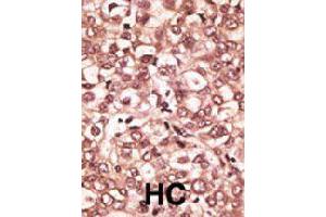 Formalin-fixed and paraffin-embedded human hepatocellular carcinoma tissue reacted with TLR6 polyclonal antibody  , which was peroxidase-conjugated to the secondary antibody, followed by AEC staining.