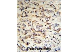 CPN2 Antibody (N-term) (R) IHC analysis in formalin fixed and paraffin embedded human breast carcinoma tissue followed by peroxidase conjugation of the secondary antibody and DAB staining. (CPN2 antibody  (N-Term))