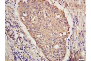 Formalin-fixed and paraffin embedded Human lung carcinoma labeled with Anti-IRF9 Polyclonal Antibody, Unconjugated (ABIN2177064) at 1:300 followed by conjugation to the secondary antibody and DAB staining (IRF9 antibody  (AA 101-200))