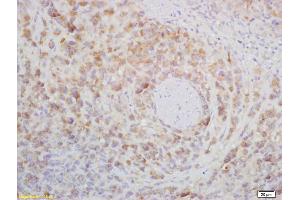 Formalin-fixed and paraffin embedded mouse lymphoma labeled with Rabbit Anti CD272/BTLA Polyclonal Antibody, Unconjugated (ABIN671031) at 1:200 followed by conjugation to the secondary antibody and DAB staining
