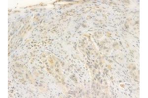 ABIN6256197 and ABIN6267469 at 1/100 staining human tongue carcinoma by IHC-P.