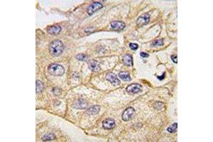 IHC analysis of FFPE human lung carcinoma tissue stained with anti-TLR2 antibody (TLR2 antibody  (AA 720-749))