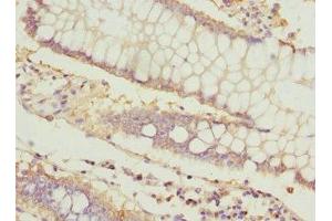 Immunohistochemistry of paraffin-embedded human colon cancer using ABIN7156542 at dilution of 1:100 (ICAM4 antibody  (AA 20-140))