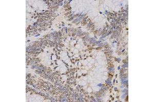 Immunohistochemistry of paraffin-embedded human rectal cancer tissue using H3K79me3 antibody at dilution of 1:200 (x400 lens). (Histone 3 antibody  (H3K79me3))