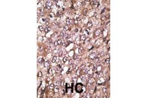 Formalin-fixed and paraffin-embedded human cancer tissue reacted with the primary antibody, which was peroxidase-conjugated to the secondary antibody, followed by AEC staining. (ATG4A antibody  (AA 1-30))