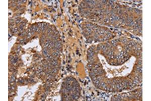The image on the left is immunohistochemistry of paraffin-embedded Human colon cancer tissue using ABIN7130361(NDUFA1 Antibody) at dilution 1/70, on the right is treated with fusion protein. (NDUFA1 antibody)