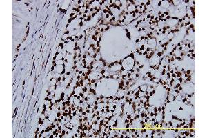 Immunoperoxidase of monoclonal antibody to NPM1 on formalin-fixed paraffin-embedded human ovary, clear cell carcinoma tissue. (NPM1 antibody  (AA 1-294))