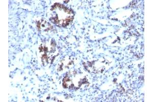 Formalin-fixed, paraffin-embedded human Colon Carcinoma stained with Transgelin Monoclonal Antibody (SPM606)