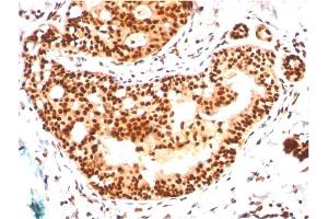 Formalin-fixed, paraffin-embedded human Breast Carcinoma stained with SUMO-2/3 Mouse Monoclonal Antibody (SM23/496) (SUMO2 antibody)