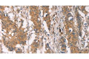 Immunohistochemistry of paraffin-embedded Human gastric cancer using PLIN2 Polyclonal Antibody at dilution of 1:30 (ADRP antibody)
