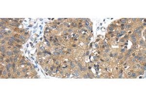 Immunohistochemistry of paraffin-embedded Human breast cancer tissue using TMPRSS11E Polyclonal Antibody at dilution 1:45 (TMPRSS11E antibody)