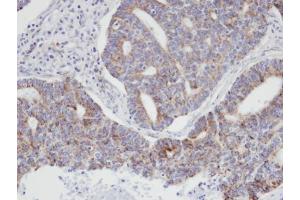 IHC-P Image Immunohistochemical analysis of paraffin-embedded human endo mitral ovarian cancer, using ARPC3, antibody at 1:100 dilution. (ARPC3 antibody)
