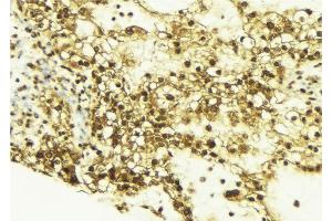 ABIN6269162 at 1/100 staining Human breast cancer tissue by IHC-P. (CREB1 antibody  (Internal Region))