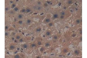 Detection of GCLM in Human Liver cancer Tissue using Polyclonal Antibody to Glutamate Cysteine Ligase, Modifier Subunit (GCLM)