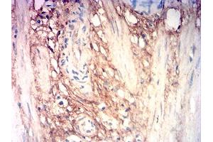 Immunohistochemical analysis of paraffin-embedded stomach cancer tissues using COL3A1 mouse mAb with DAB staining. (COL3A1 antibody  (AA 24-153))