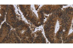 Immunohistochemistry of paraffin-embedded Human colon cancer tissue using PIP Polyclonal Antibody at dilution 1:50 (PIP antibody)