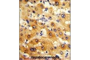 Formalin-fixed and paraffin-embedded human hepatocarcinoma reacted with RPS15 Antibody (N-term), which was peroxidase-conjugated to the secondary antibody, followed by DAB staining. (RPS15 antibody  (N-Term))