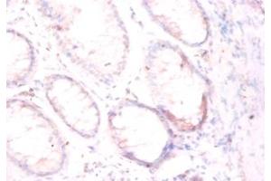 Immunohistochemistry of paraffin-embedded human colorectal carcinoma using FOLH1 / PSMA antibody at dilution of 1:50. (PSMA antibody  (Biotin))