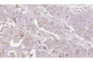 ABIN6272715 at 1/100 staining Human liver cancer tissue by IHC-P. (OR1E2 antibody  (C-Term))