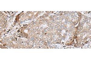 Immunohistochemistry of paraffin-embedded Human liver cancer tissue using MRM1 Polyclonal Antibody at dilution of 1:85(x200) (MRM1 antibody)