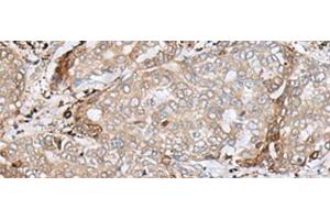 Immunohistochemistry of paraffin-embedded Human liver cancer tissue using MRM1 Polyclonal Antibody at dilution of 1:85(x200)