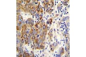 Formalin fixed, paraffin embedded human hepatocarcinoma stained with CYP2B6 Antibody (Center) followed by peroxidase conjugation of the secondary antibody and DAB staining. (CYP2B6 antibody  (Middle Region))