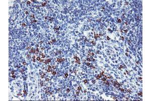 Immunohistochemical staining of paraffin-embedded Human lymphoma tissue using anti-IGJ mouse monoclonal antibody. (IGJ antibody)