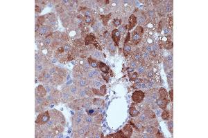 Immunohistochemistry of paraffin-embedded human liver cancer using Cyclin B2 Rabbit mAb (ABIN7266557) at dilution of 1:100 (40x lens). (Cyclin B2 antibody)