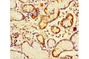 Immunohistochemistry of paraffin-embedded human gastric cancer using ABIN7162782 at dilution of 1:100 (PGLYRP4 antibody  (AA 18-317))