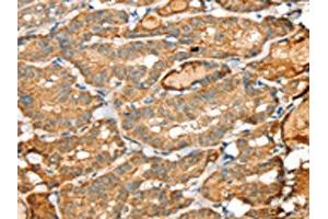 The image on the left is immunohistochemistry of paraffin-embedded Human thyroid cancer tissue using ABIN7192361(SIGLEC14 Antibody) at dilution 1/30, on the right is treated with synthetic peptide. (SIGLEC14 antibody)