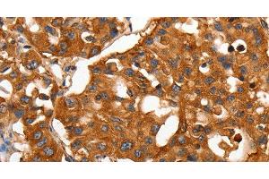 Immunohistochemistry of paraffin-embedded Human lung cancer using CAP2 Polyclonal Antibody at dilution of 1:50 (CAP2 antibody)