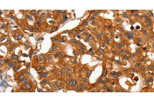 Immunohistochemistry of paraffin-embedded Human lung cancer using CAP2 Polyclonal Antibody at dilution of 1:50