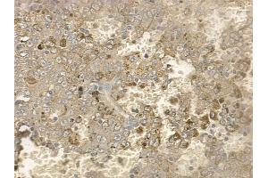 ABIN6256168 and ABIN6267171 at 1/100 staining human melanoma by IHC-P.