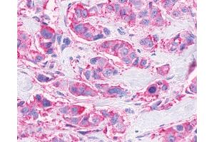 Anti-FFAR3 / GPR41 antibody IHC of human Breast, Carcinoma. (FFAR3 antibody  (Internal Region))