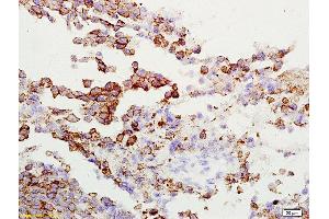 Formalin-fixed and paraffin embedded rat lung carcinoma labeled with Anti-Gamma-Adaptin Polyclonal Antibody, Unconjugated  at 1:200 followed by conjugation to the secondary antibody and DAB staining