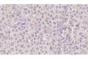 ABIN6276805 at 1/100 staining Human melanoma tissue by IHC-P.