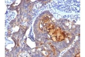 Immunohistochemical staining (Formalin-fixed paraffin-embedded sections) of human colon carcinoma with ECM1 monoclonal antibody, clone ECM1/792 . (ECM1 antibody)