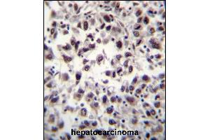 SFRS7 Antibody (N-term) (ABIN656240 and ABIN2845556) immunohistochemistry analysis in formalin fixed and paraffin embedded human hepatocarcinoma tissue followed by peroxidase conjugation of the secondary antibody and DAB staining. (SFRS7 antibody  (N-Term))