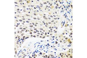 Immunohistochemistry of paraffin-embedded human lung cancer using MYOG antibody (ABIN5974015) at dilution of 1/100 (40x lens). (Myogenin antibody)