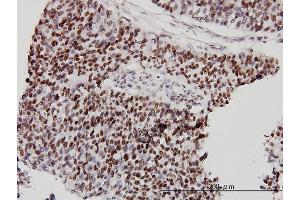 Immunoperoxidase of monoclonal antibody to CHD4 on formalin-fixed paraffin-embedded human transitional cell carcinoma.