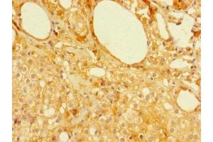 Immunohistochemistry of paraffin-embedded human prostate cancer using ABIN7160129 at dilution of 1:100 (MFSD5 antibody  (AA 216-248))