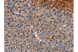 The image on the left is immunohistochemistry of paraffin-embedded Human breast cancer tissue using ABIN7130441(NOC2L Antibody) at dilution 1/20, on the right is treated with fusion protein. (NOC2L antibody)